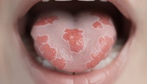 découvrez les causes, symptômes et traitements du psoriasis lingual pour mieux comprendre cette affection peu connue et améliorer votre confort buccal.